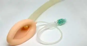 Влияние применения ларингеальной маски на исходы со стороны дыхательных путей при родоразрешении путем кесарева сечения под общей анестезией
