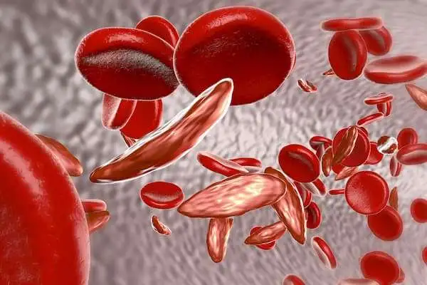 Кризанлизумаб эффективен в терапии болевых кризов при серповидно-клеточной анемии