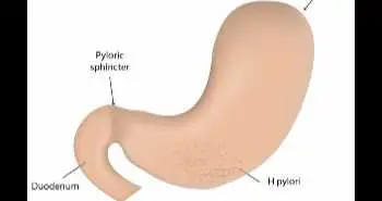 Оценка эффективности новой поэтапной схемы лечения инфекции H. pylori, включающей применение препарата висмута