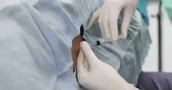 Нейроаксиальная анестезия предпочтительна при проведении реваскуляризации нижних конечностей
