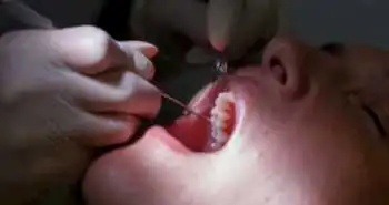 Оценка качества жизни, связанного со здоровьем полости рта у пациентов с установленными зубочелюстными мини-имплантами