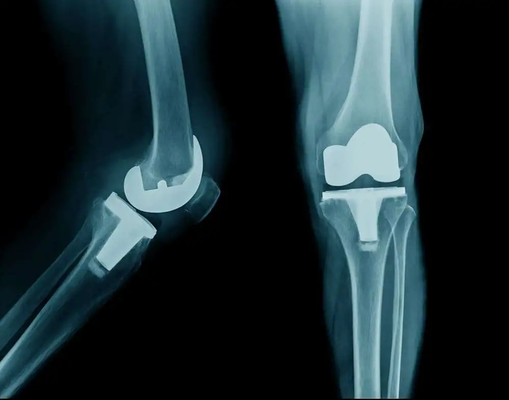 Применение анестезирующих и болеутоляющих средств в рамках программ краткосрочной госпитализации при артропластике коленного сустава