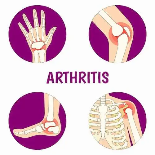 Рекомендации EULAR по диагностике и лечению раннего артрита: 2016