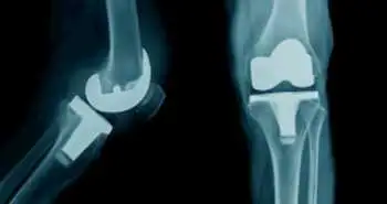 Инъекции сприфермина при остеоартрозе коленного сустава признаны безопасными