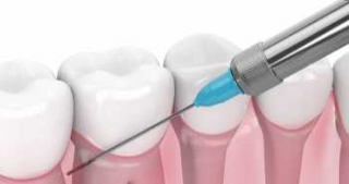 Доказана эффективность и безопасность модифицированной пародонтальной анестезии при лечении кариеса зубов