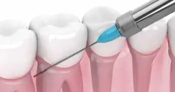 Ketorolac trometamol: An effective preventive analgesia to treat acute pulpitis in molars