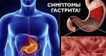Кайбышева В.О: «Функциональная диспепсия с позиции доказательной гастроэнтерологии»