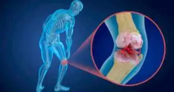 Прием добавок с витамином D позволяет снизить интенсивность боли при остеоартрите коленного сустава