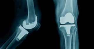 Эффективность применения мелоксикама для облегчения послеоперационной боли при эндопротезировании коленного сустава