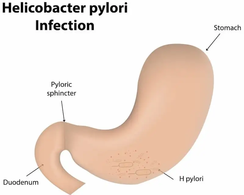 Helicobacter_pylori_(H._pylori)