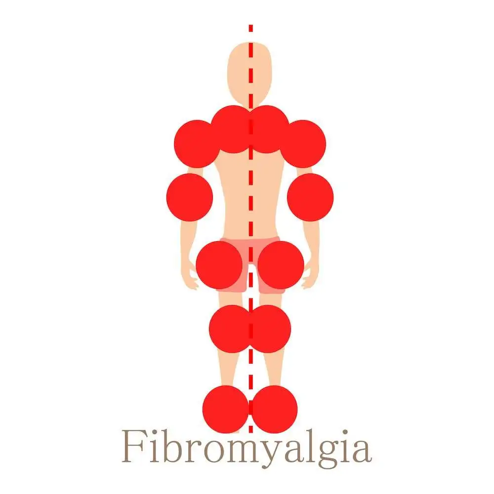 Фибромиалгия