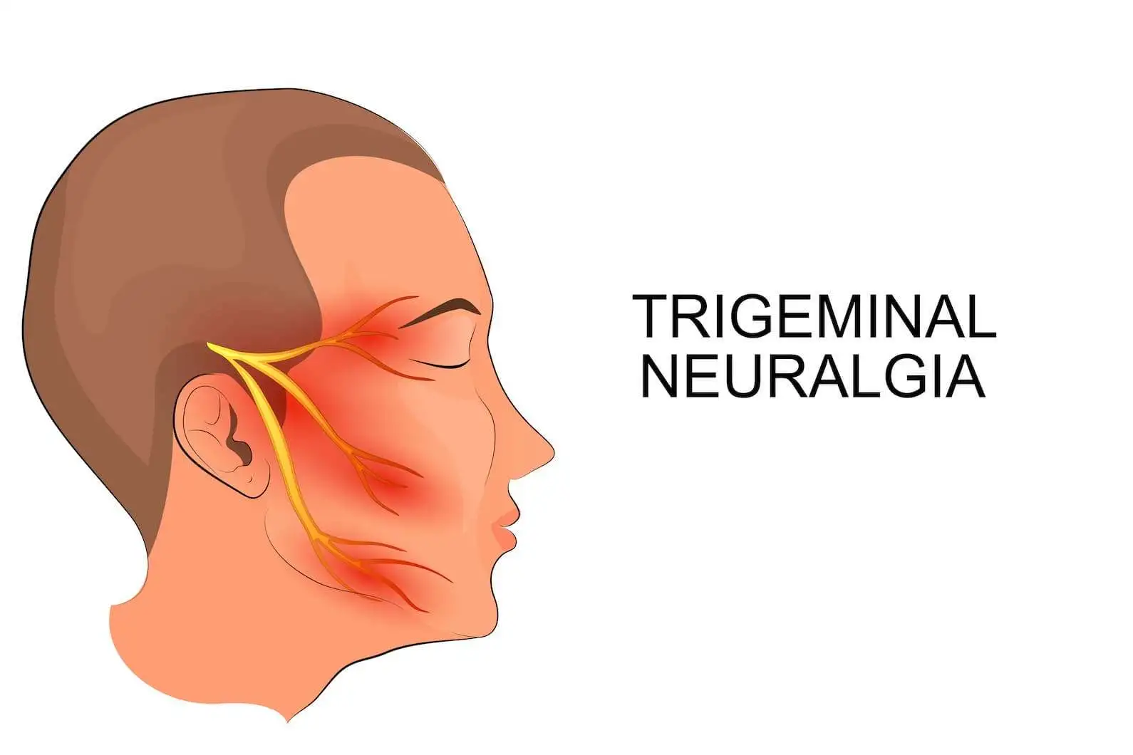 Подкожная нейростимуляция зоны иннервации тройничного нерва при лечении рефрактерной тригеминальной невралгии: когортный анализ