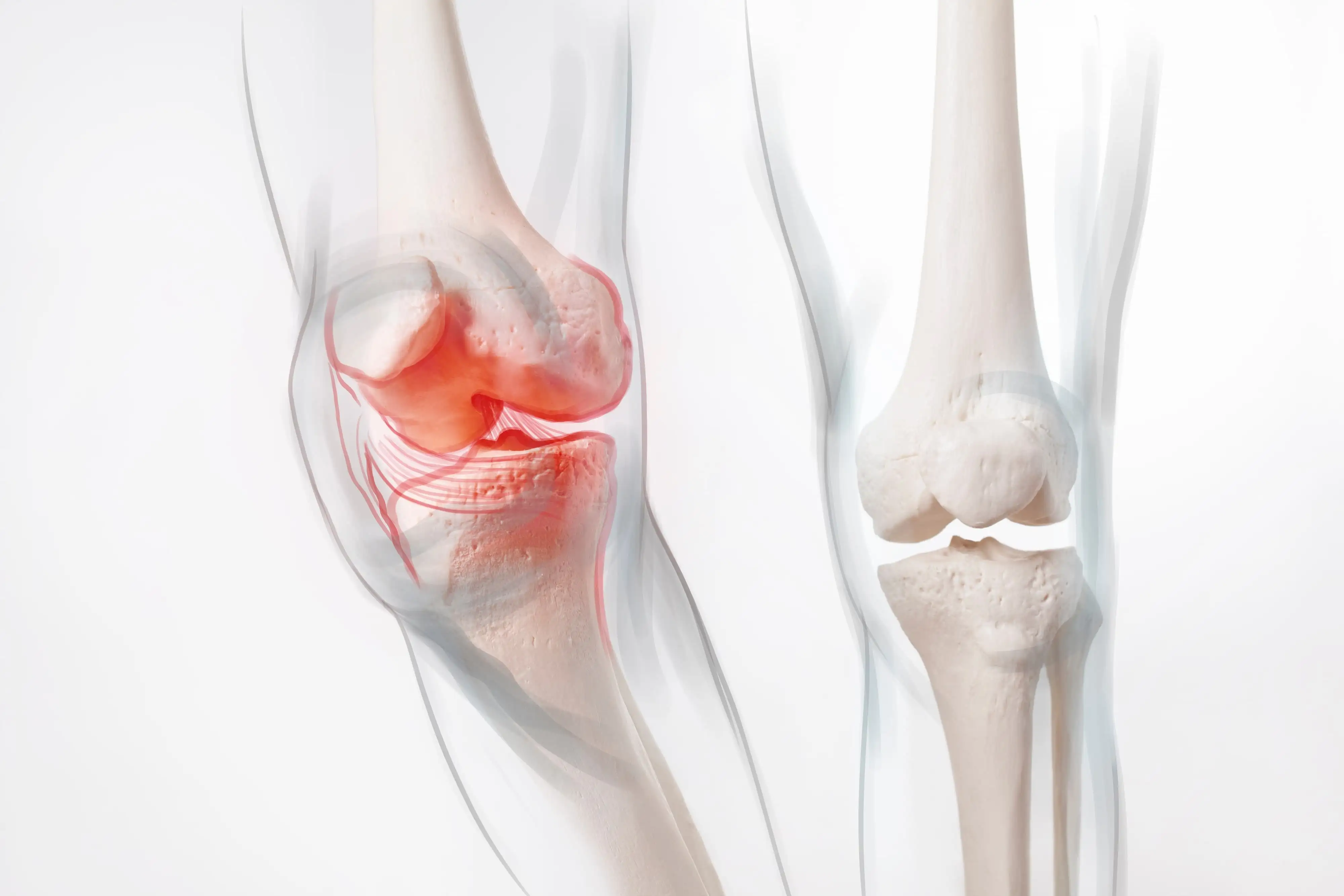 остеоартроз коленного сустава.