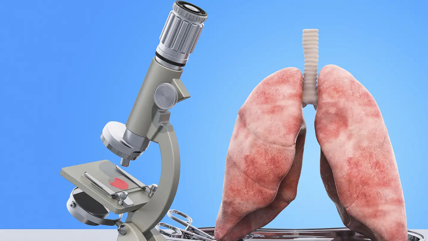 Проблема распространения субклинического туберкулёза лёгких