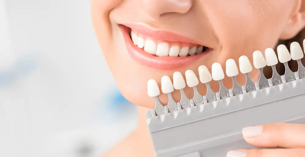 Dental bleaching