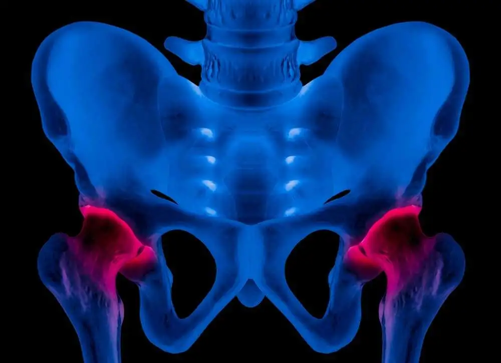 Новые связующие аспекты между феморо-ацетабулярным импиджментом и болью в переднем отделе коленного сустава