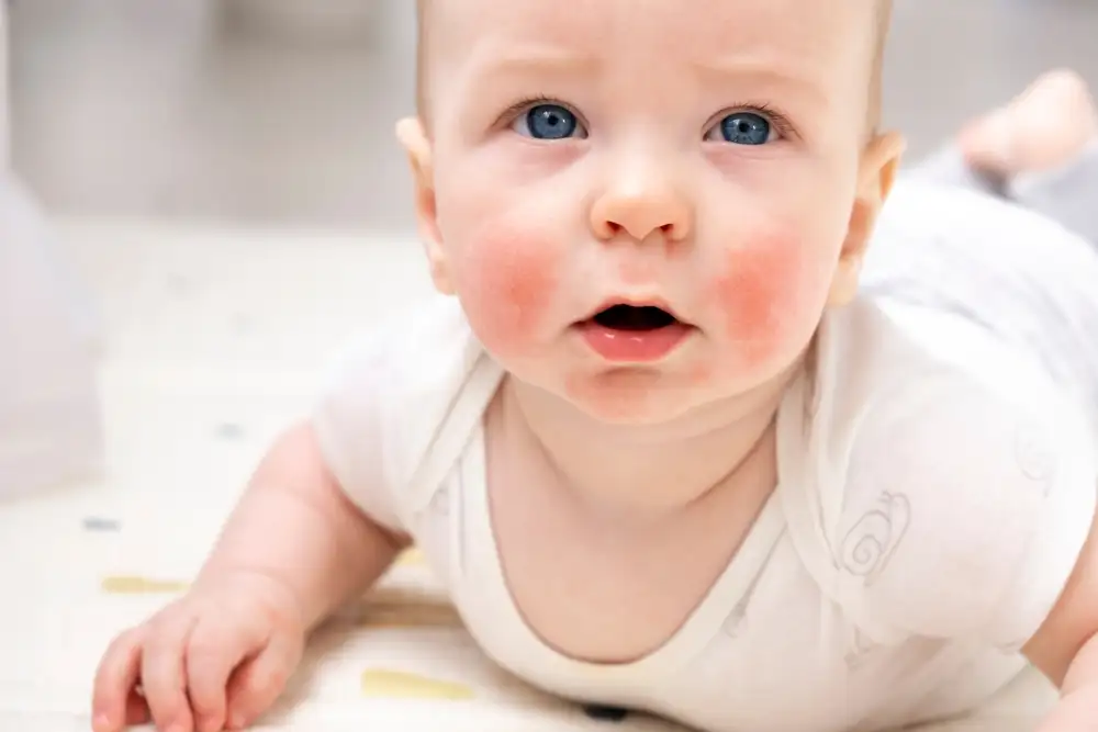 Atopic dermatitis