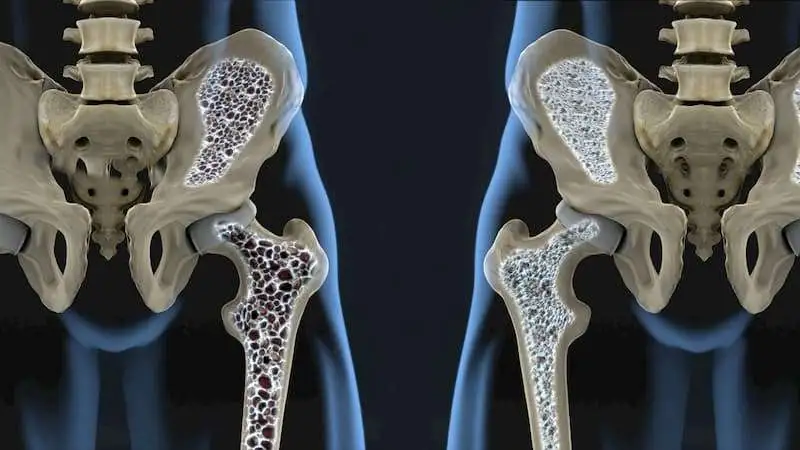 Влияние тяжелых металлов на микроархитектуру кости при остеопорозе