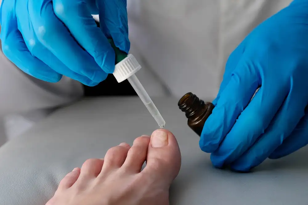 Onychomycosis